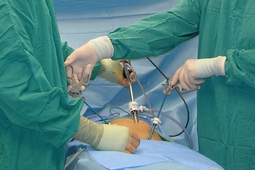 جراحی آپاندیسیت توسط دکتر فریبرز ملکی